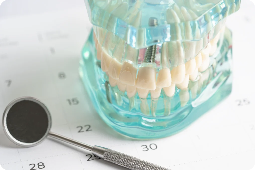 implant dentaire Implants dentaires Eurêka dentaire - Chirurgiens-dentistes à Castelnau-le-Lez