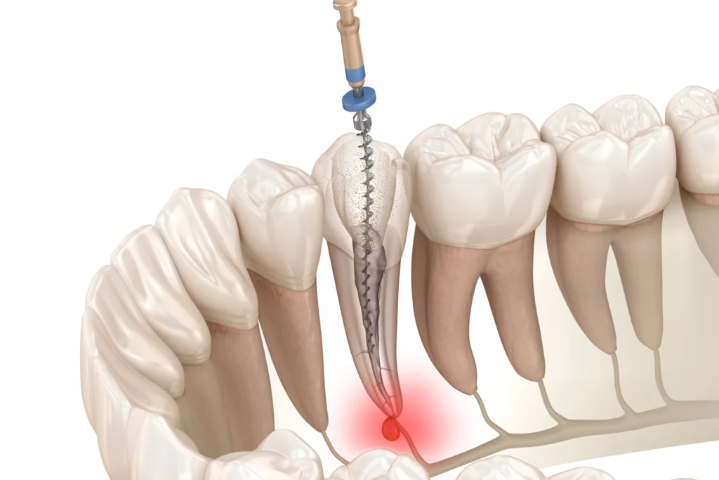 retraitement endodontique castelnau le lez Endodontie Eurêka dentaire - Chirurgiens-dentistes à Castelnau-le-Lez