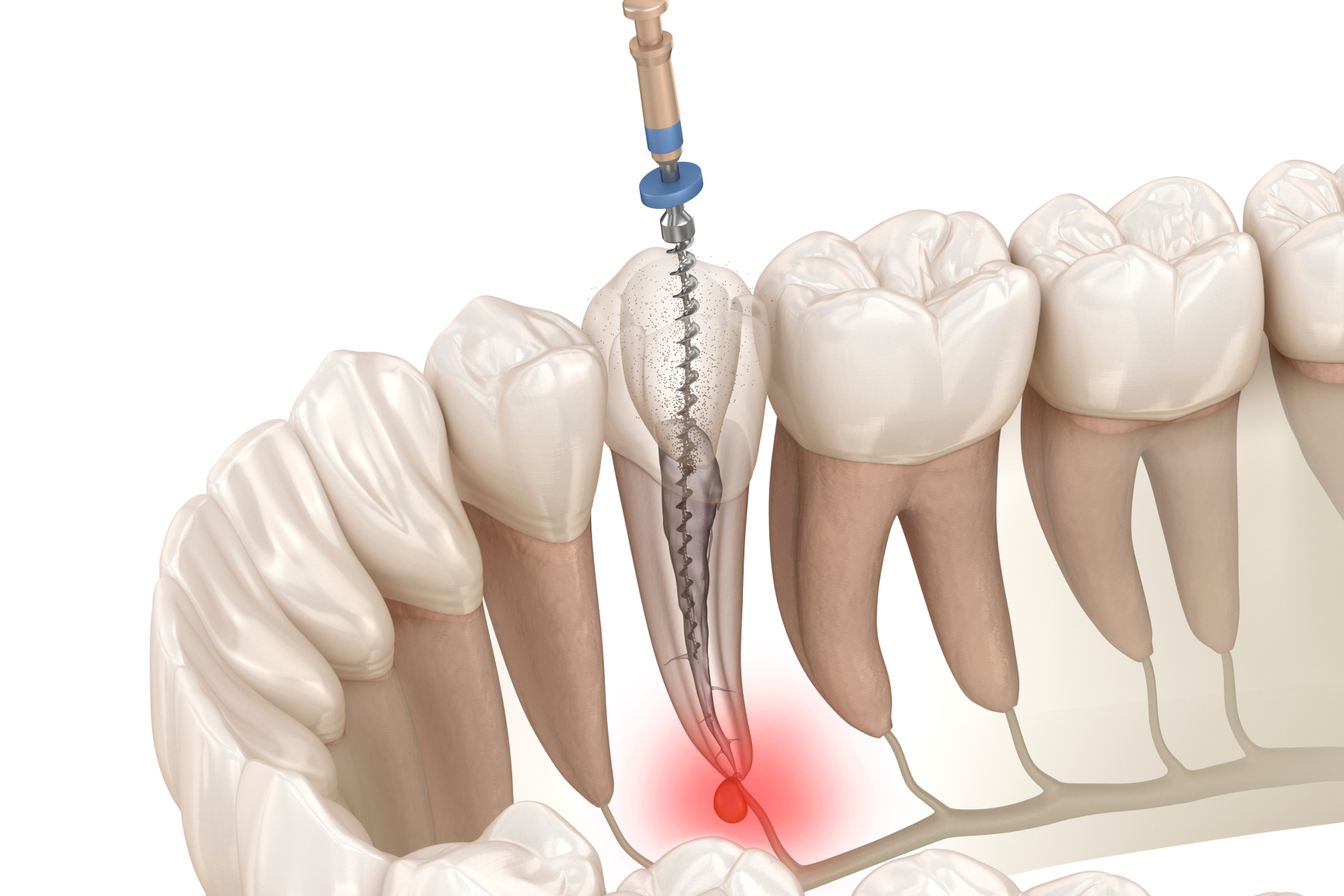 retraitement endodontique castelnau le lez Endodontie Eurêka dentaire - Chirurgiens-dentistes à Castelnau-le-Lez
