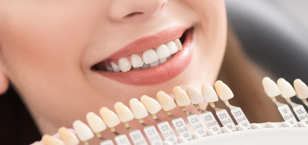 facettes dentaires montferrier sur lez Soins esthétiques Eurêka dentaire - Chirurgiens-dentistes à Castelnau-le-Lez
