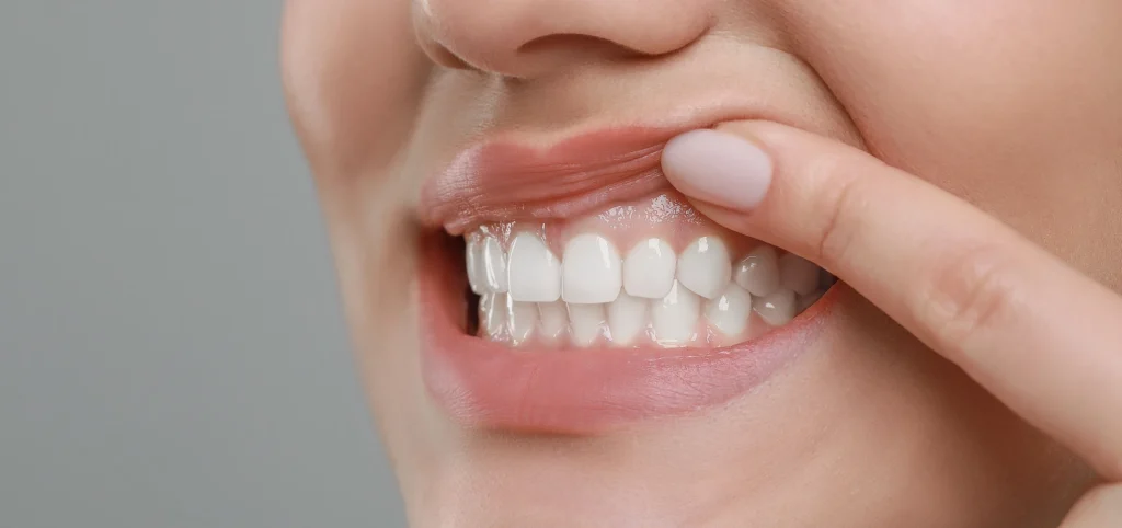 soins gencives Soins des gencives Eurêka dentaire - Chirurgiens-dentistes à Castelnau-le-Lez