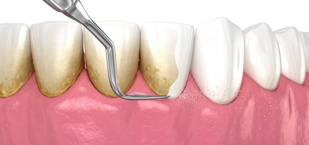 surfacage radiculaire detartrage Soins des gencives Eurêka dentaire - Chirurgiens-dentistes à Castelnau-le-Lez