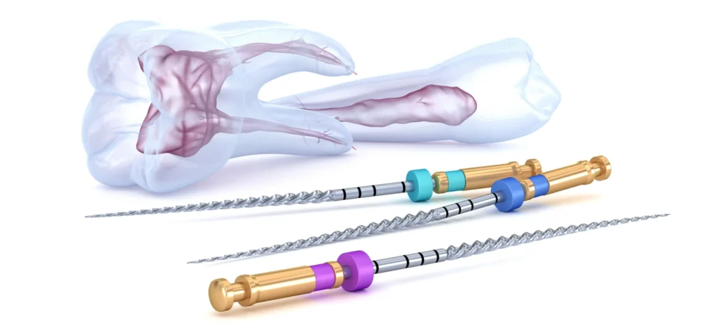 endodontie devitalisation Nos soins dentaires Eurêka dentaire - Chirurgiens-dentistes à Castelnau-le-Lez