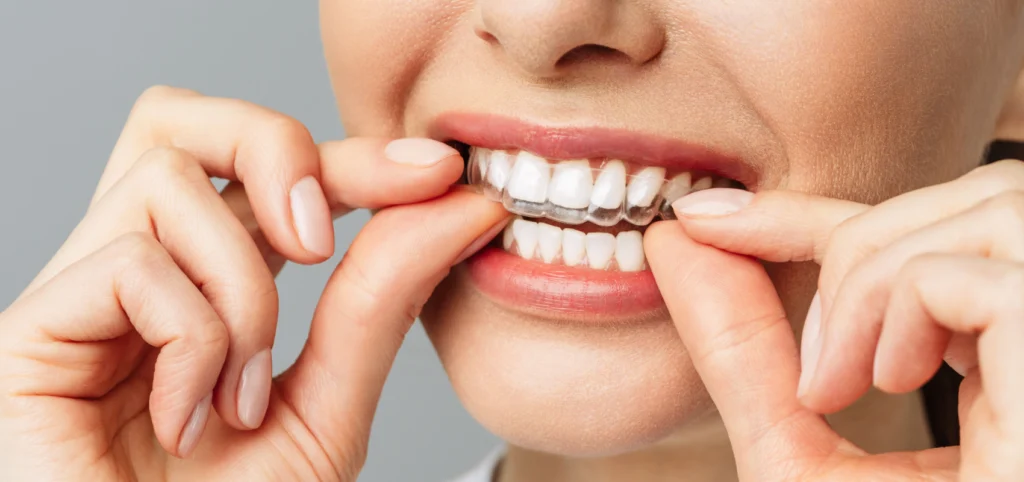 gouttiere invisible montpellier Soins esthétiques Eurêka dentaire - Chirurgiens-dentistes à Castelnau-le-Lez