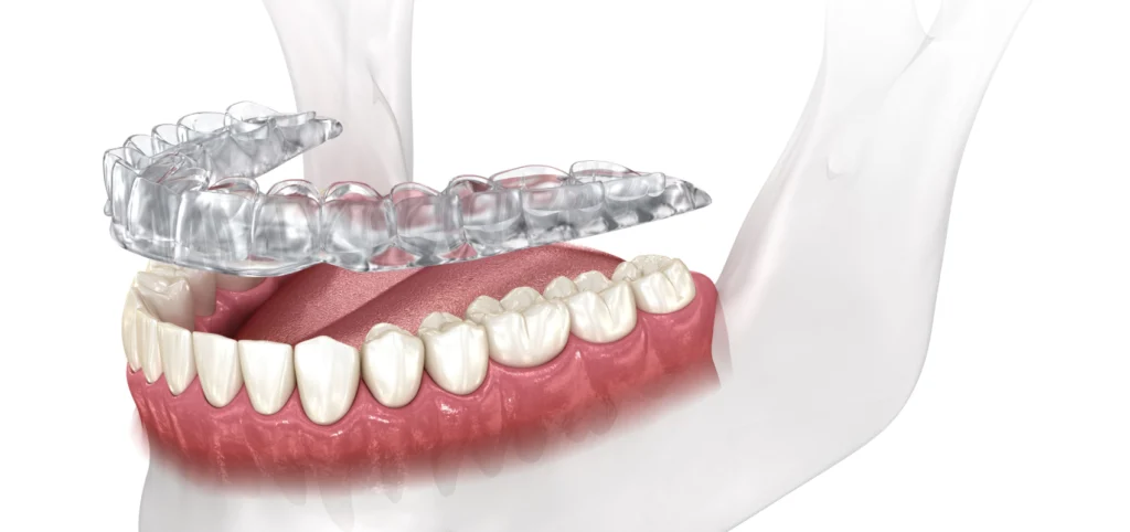 bruxisme dentaire dentiste Le bruxisme Eurêka dentaire - Chirurgiens-dentistes à Castelnau-le-Lez