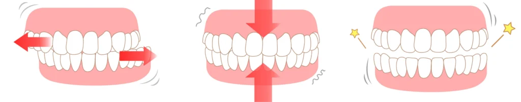 bruxisme dentaire montferrier sur lez Le bruxisme Eurêka dentaire - Chirurgiens-dentistes à Castelnau-le-Lez
