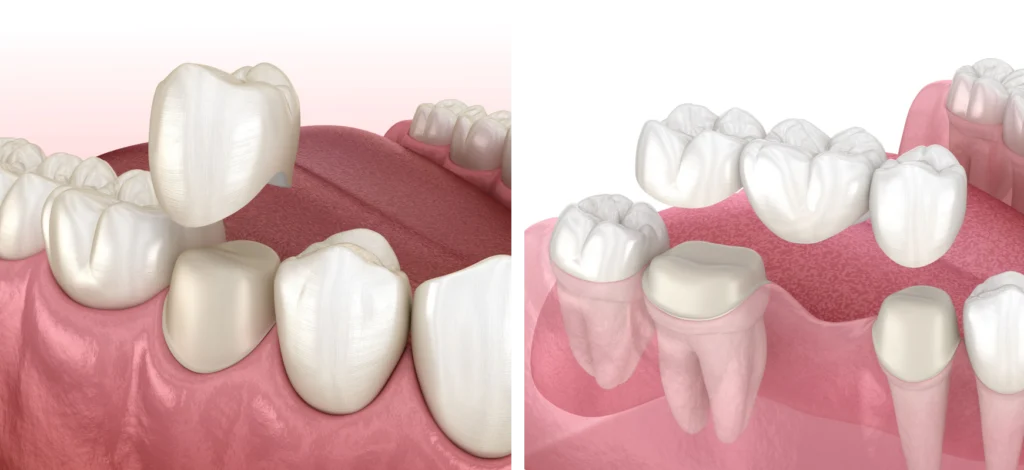 couronnes ponts bridge dentaire Chirurgie orale Eurêka dentaire - Chirurgiens-dentistes à Castelnau-le-Lez