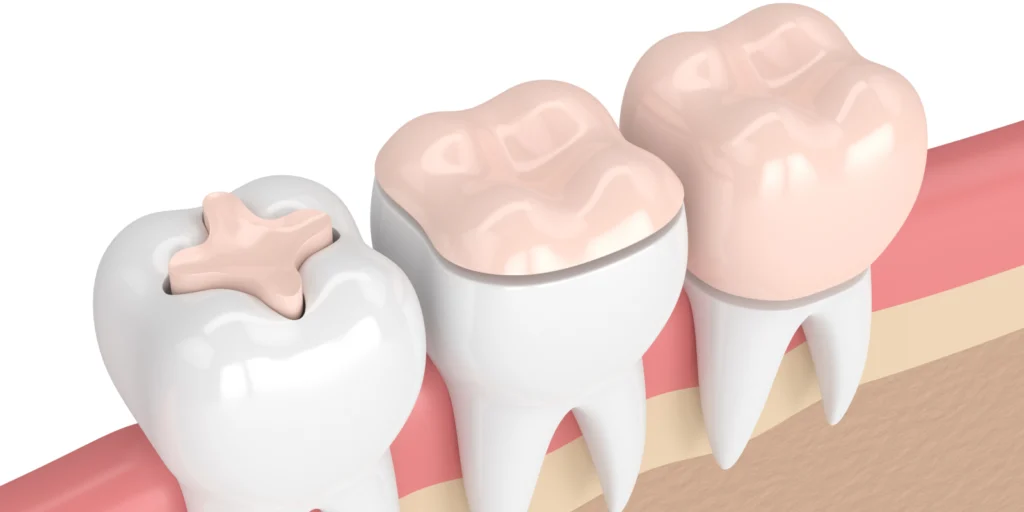 inlay onlay overlay Nos soins dentaires Eurêka dentaire - Chirurgiens-dentistes à Castelnau-le-Lez