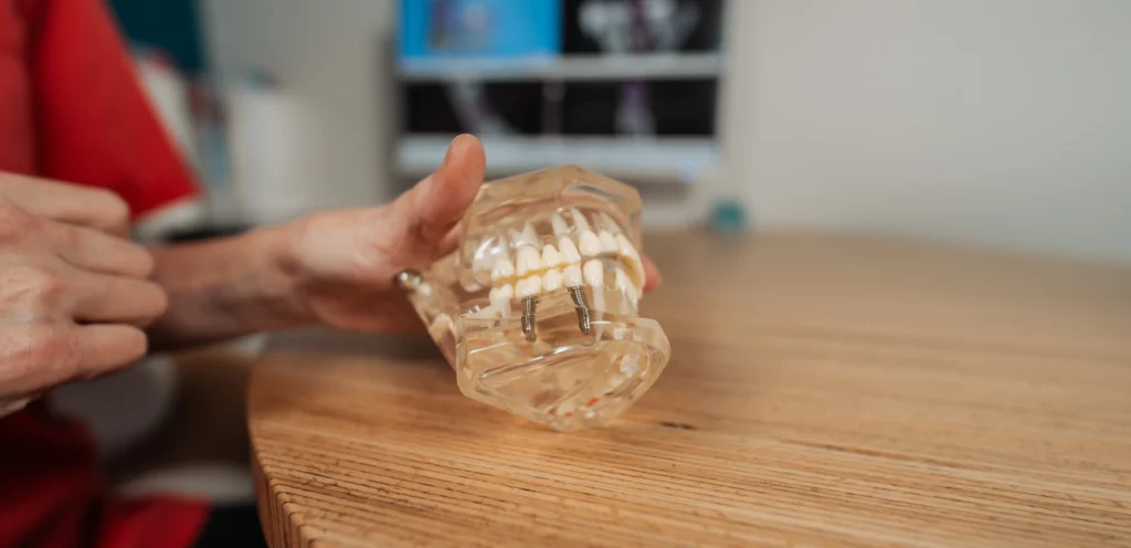 implant dentaire le clapier Dentiste à Le Clapier : implants dentaires Eurêka dentaire - Chirurgiens-dentistes à Castelnau-le-Lez