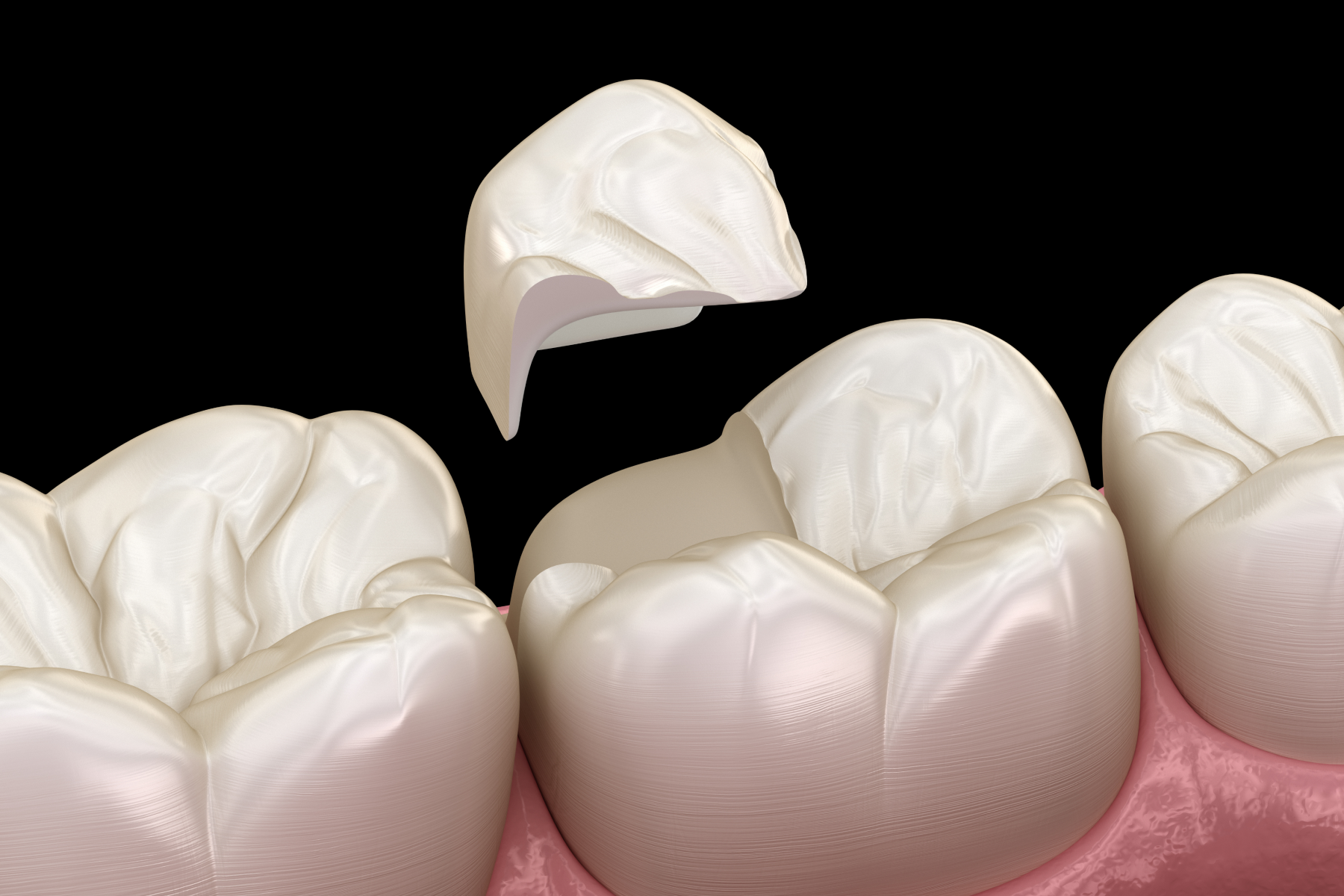 carie composite dentaire Soins conservateurs Eurêka dentaire - Chirurgiens-dentistes à Castelnau-le-Lez